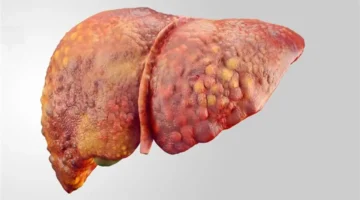 العادات اليومية الأساسية للتخلص من دهون الكبد حسب استشاري مختص 1